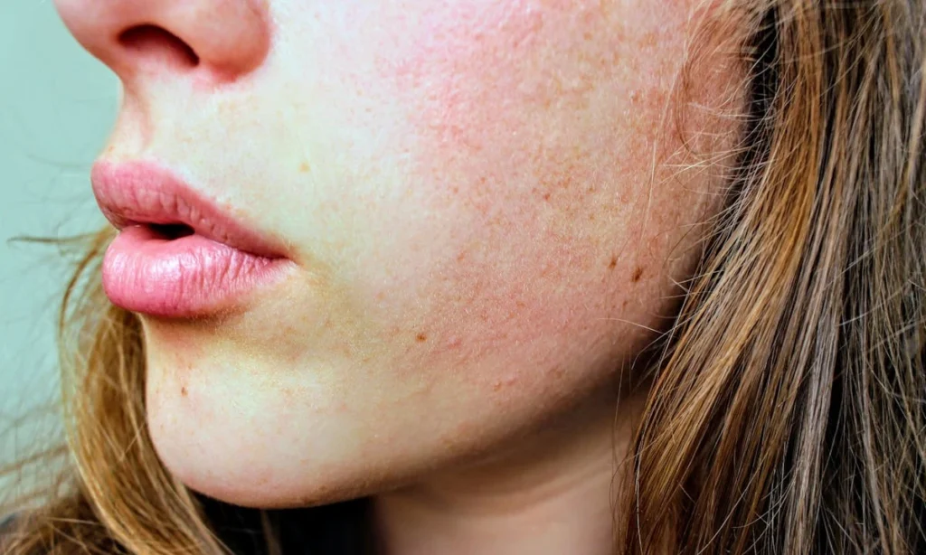 How Dry Skin Can Be Cured? 4 Proven Ways