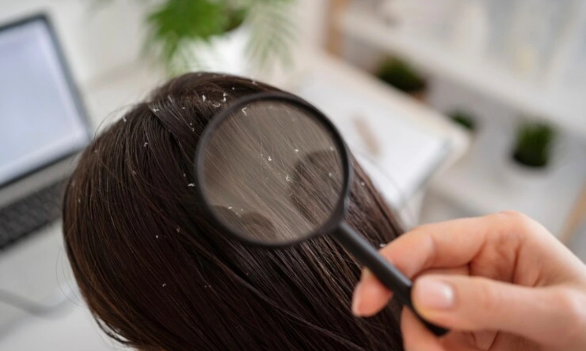 What natural ingredients are good for dandruff? Top 7 Solutions