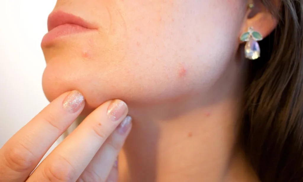 Why oily skin have pimples? 5 Shocking Causes