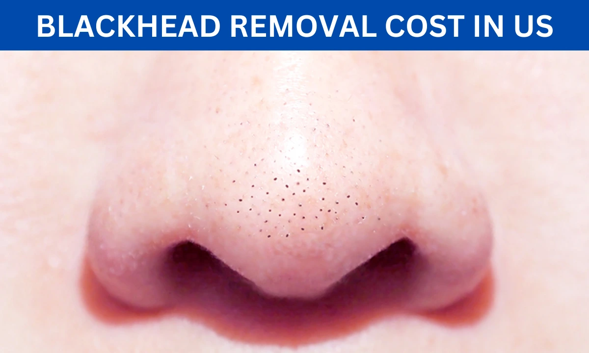 Blackhead Removal Cost in the US in 2025