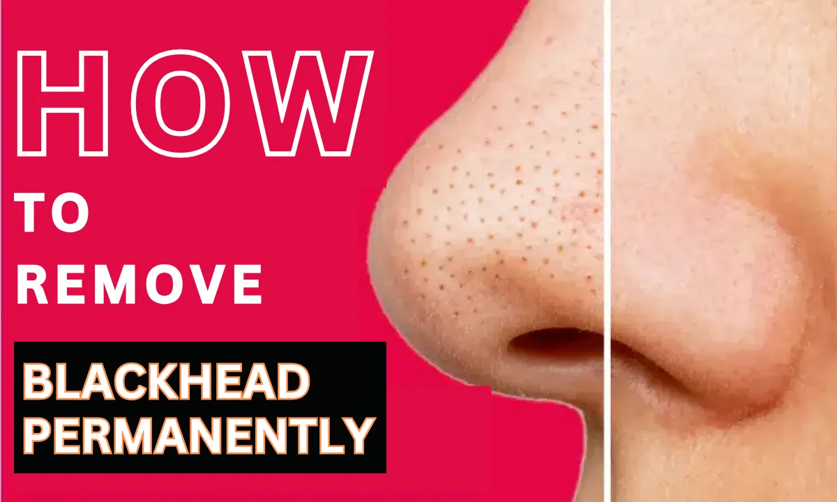 How to Remove Blackheads Permanently: 3 Surprising Solutions You Need to Try