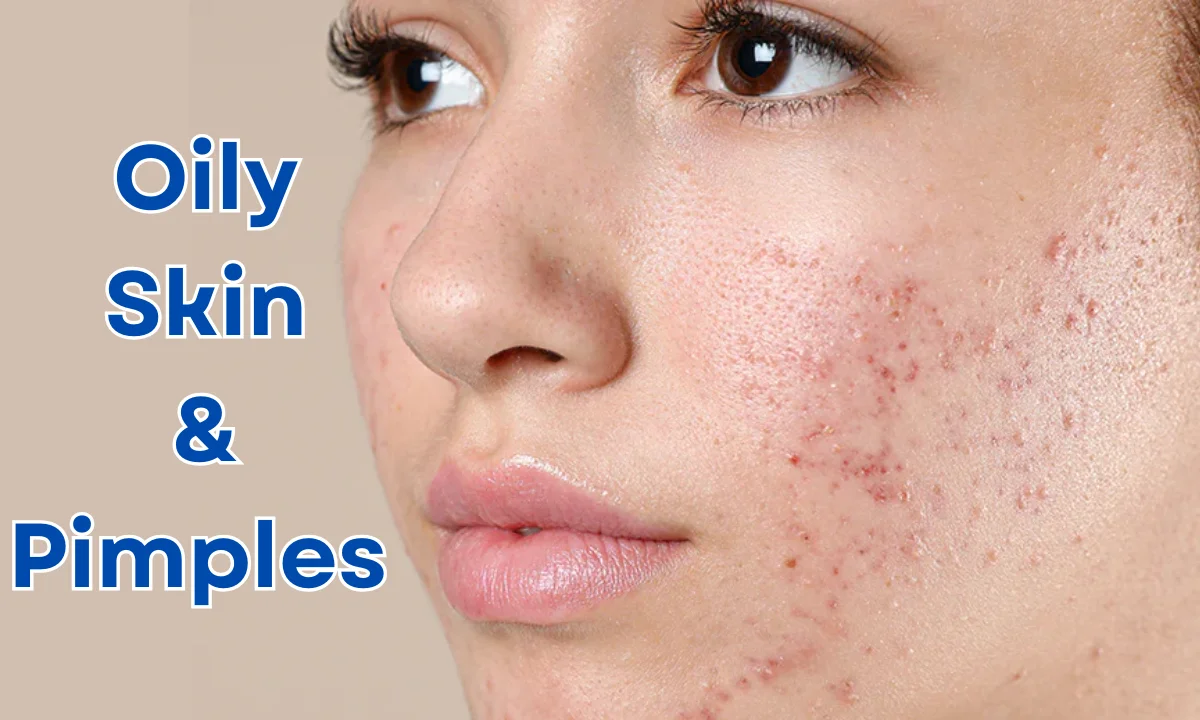 Why oily skin have pimples?